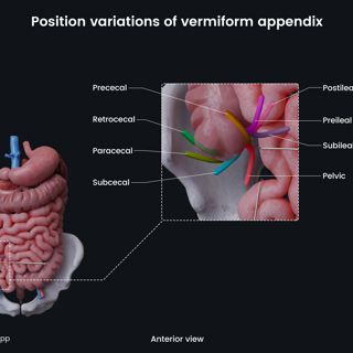 Position variations of vermiform appendix image