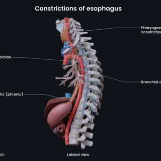 Constrictions of esophagus image