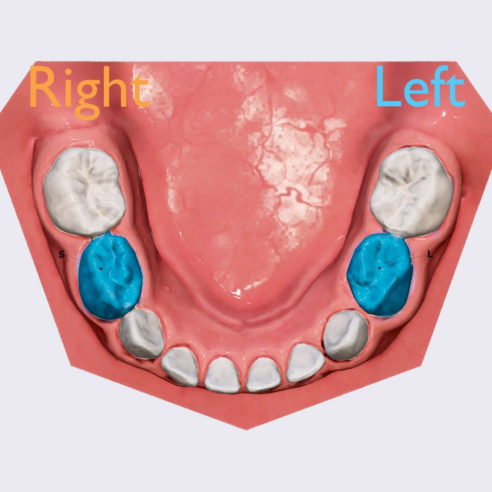 First mandibular molar tooth