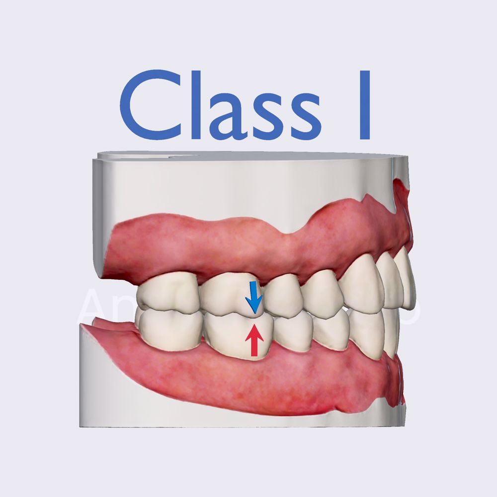 Angle's classification: Class I
