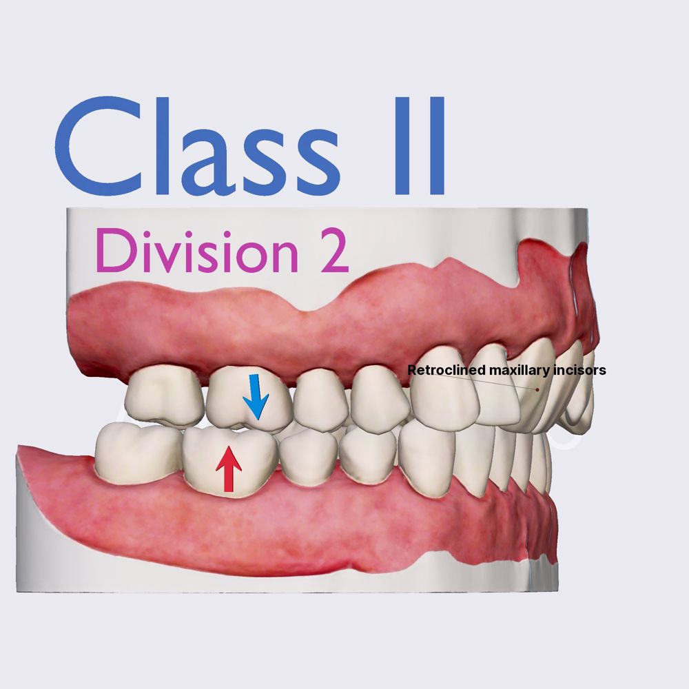 Angle's classification: Class II, Division 2