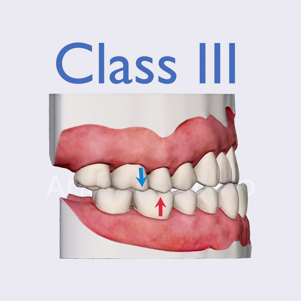 Angle's classification: Class III