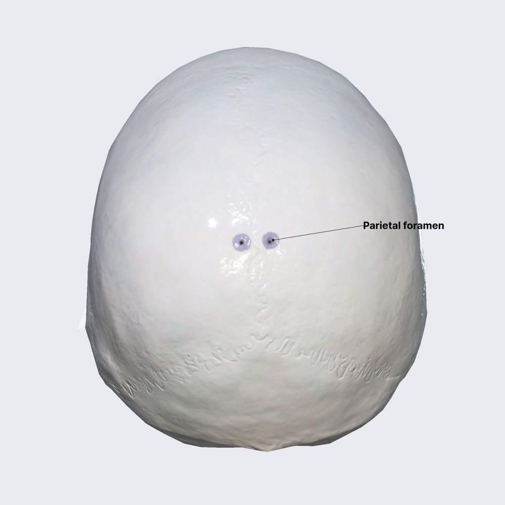 Parietal foramen