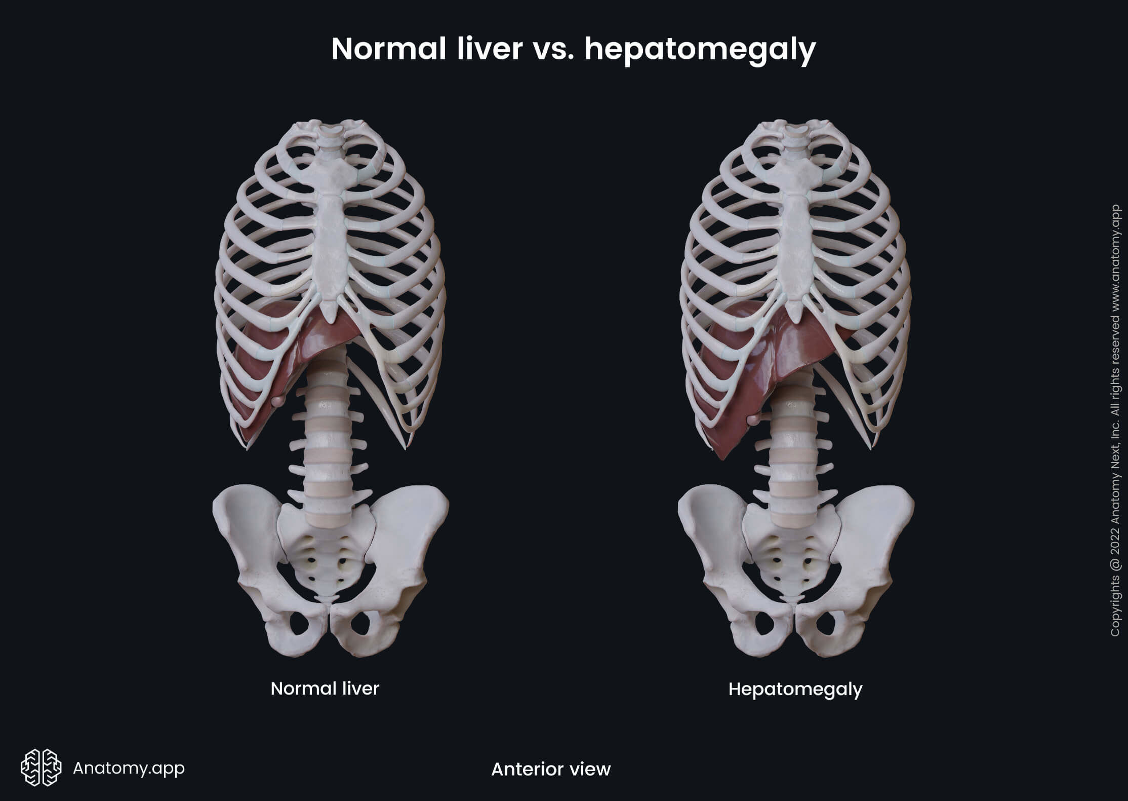 Gastrointestinal system, Liver, Hepatomegaly, Accessory organs of digestive tract, Digestive system, Anterior view, Trunk, Skeletal system, Axial skeleton 