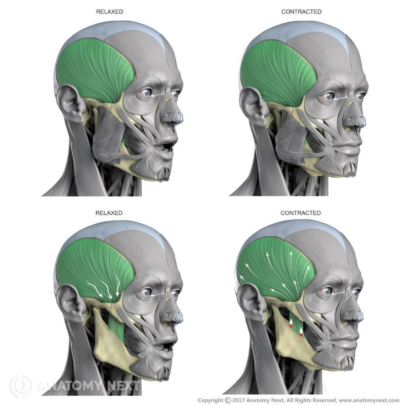 Action of temporalis, Function of temporalis, Temporalis, Relaxed temporalis, Contracted temporalis