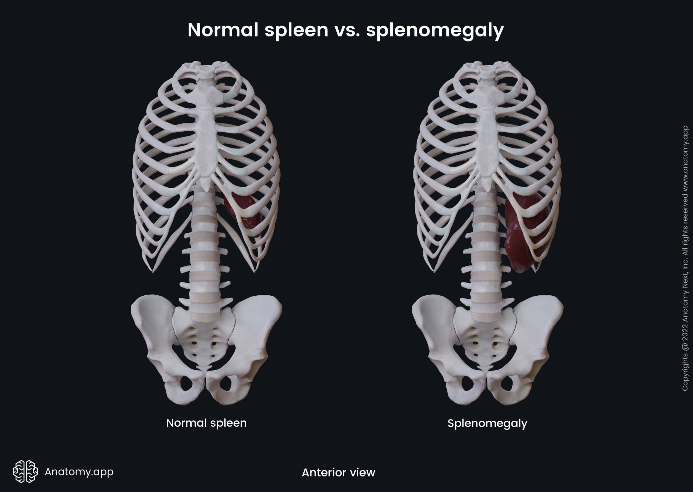 Lymphatic system, Spleen, Splenomegaly, Anterior view, Trunk, Skeletal system, Axial skeleton 