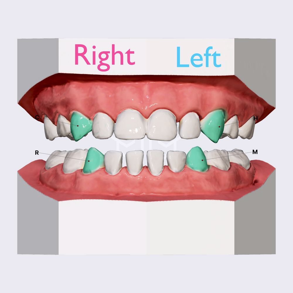 Canines (deciduous teeth)