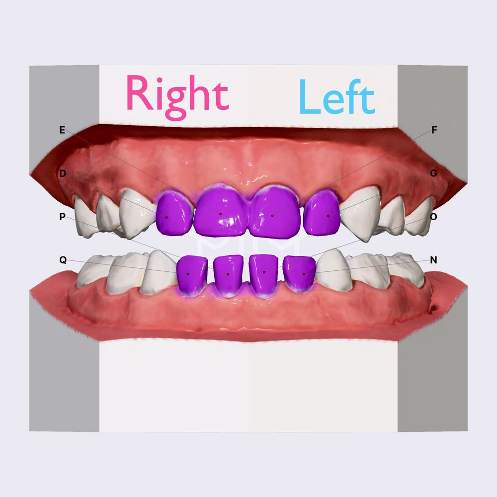 Incisors (deciduous teeth)