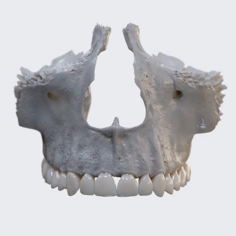 Maxilla (overview)