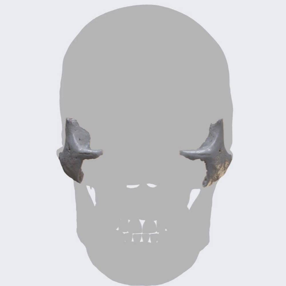 Zygomatic bone